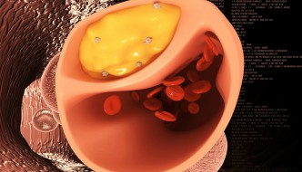 Thrombose