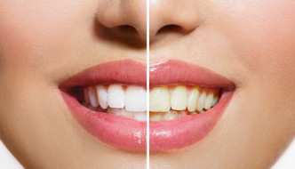 Für ein strahlend weißes Lächeln: Was man gegen gelbe Zähne tun kann